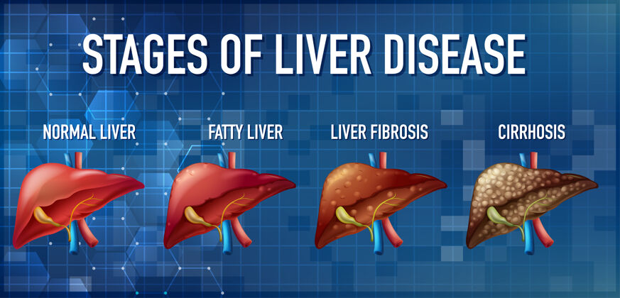 医学导致肝硬化的肝病阶段科学慢性疾病