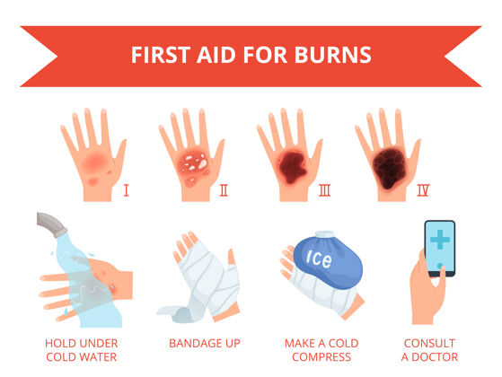 严重燃烧皮肤优先治疗人体手部火灾或化学破坏伤严重皮肤安全信息图个人效果损伤