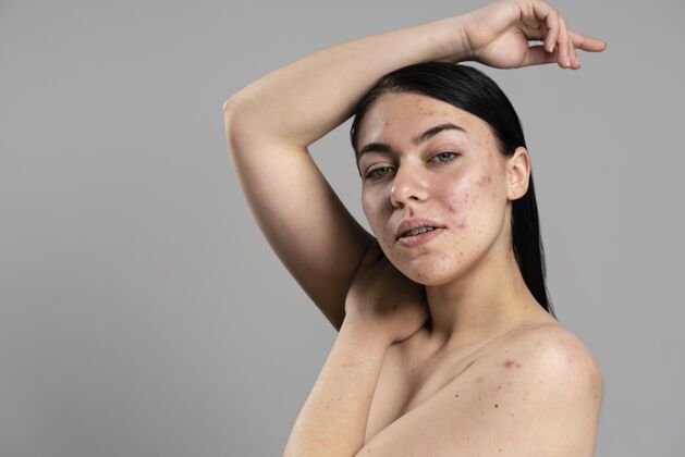 面部年轻女子自信地露出她的粉刺皮肤科油性皮肤自我护理